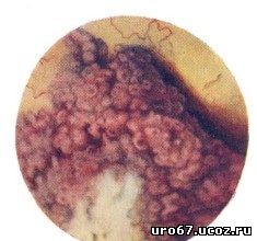 рак мочевого пузыря фото